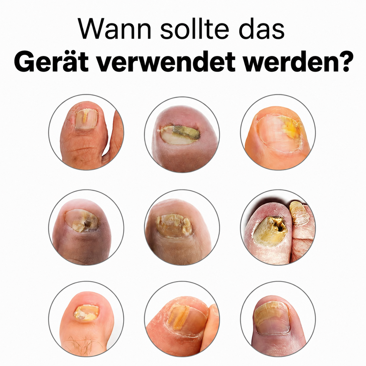 Gesunde Füße™ NagelLaser Regeneration